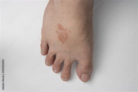 close up of foot infected with ringworm, athlete's foot or tinea pedis ...