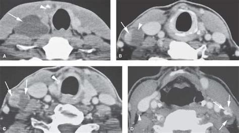 Thyroid Nodules And Malignant Tumors Radiology Key