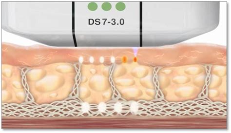 Monopolar Rf Thermage Skincentral Dermatology Aesthetics And Lasers