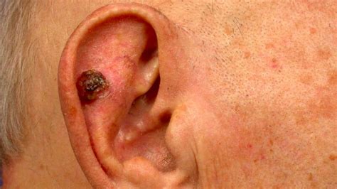 Skin Cancer Of The Ear And Surgical Reconstruction Options