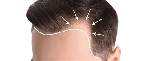 All Tips About Getting Best Hairline For Hair Transplant