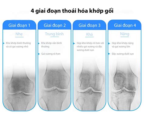 Các Giai đoạn Thoái Hóa Khớp Gối Trung Tâm Y Khoa Vạn Hạnh