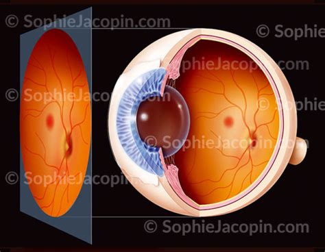 Examen Fond D Oeil Archives Illustration Medicale