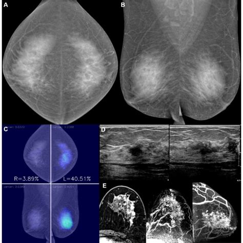 A 55 Year Old Woman With Invasive Lobular Carcinoma In The Left Breast