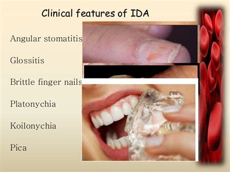 Iron Deficiency Nails Pictures Photos