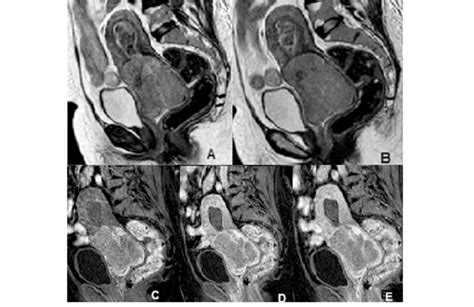 Dynamic Contrast Enhanced Mr Imaging Of The Pelvis A B Sagittal