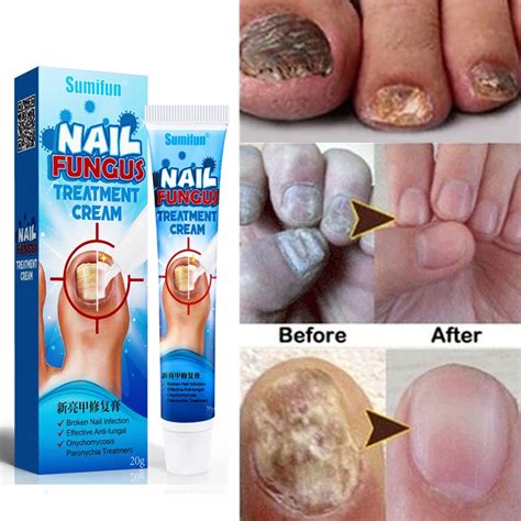 Nail Fungus Treatment Best Nail Repair Stop Fungal Growth Effective