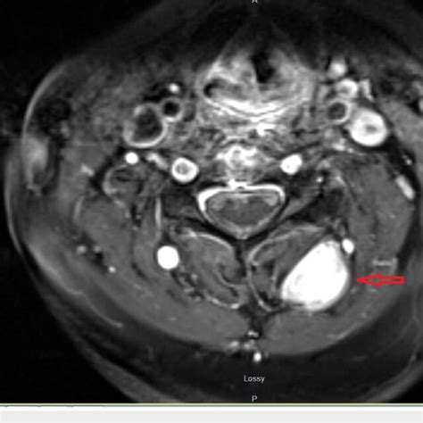 Axial MRI Postcontrast Postcontrast MRI Showing Enhancement Of The