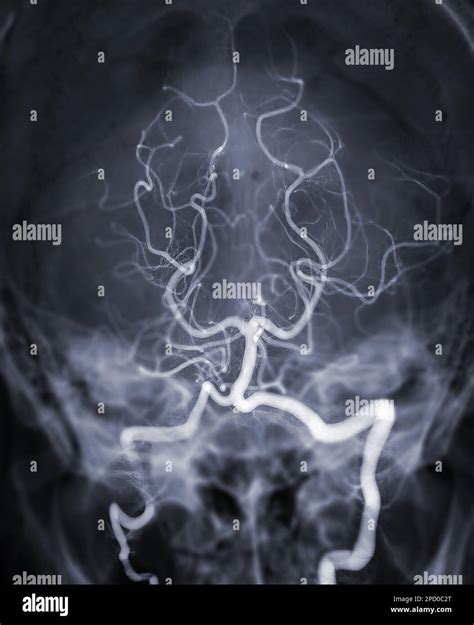 Imagen De Angiograf A Cerebral O Arteria Cerebral Potesterior De