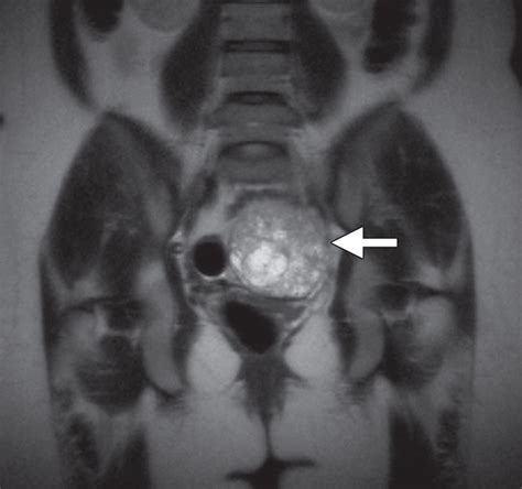 Mr Imaging Findings Of Ectopic Pregnancy A Pictorial Review Radiographics