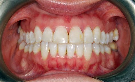 Invisalign Before After Dubbo Orthodontic Centre