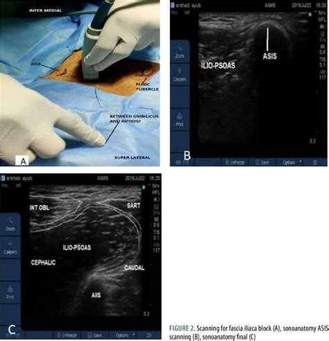 Figure From Ultrasound Guided Suprainguinal Fascia Iliaca Block To