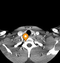 Uncinate process of first thoracic vertebra - e-Anatomy - IMAIOS