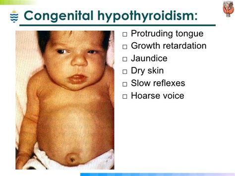 Congenital Hypothyroidism Cretinism Myxedema Congenital