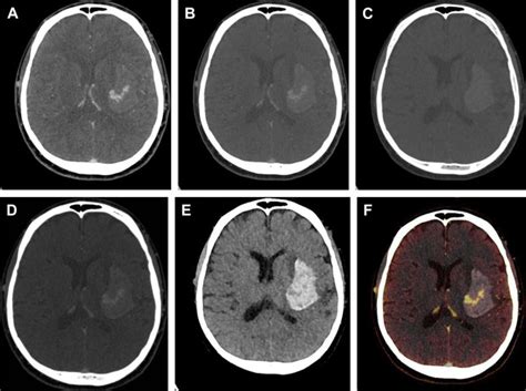 Dual Energy Computed Tomography Angiography Of The Head And Neck And