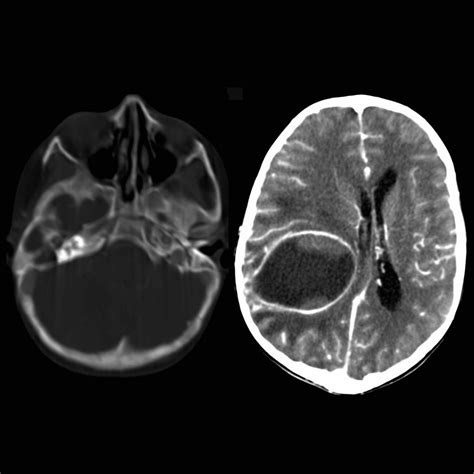 Mastoid Air Cells Mri