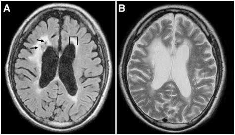 Representative Axial Flair And T Weighted Mri Images From One Patient