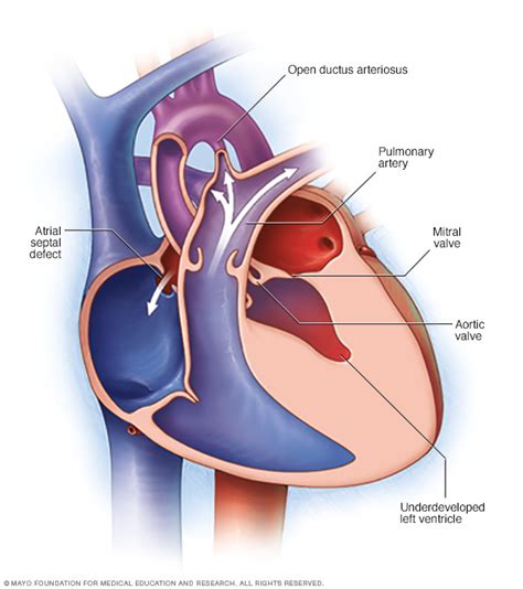 Hypoplastic left heart syndrome - Symptoms and causes - Mayo Clinic