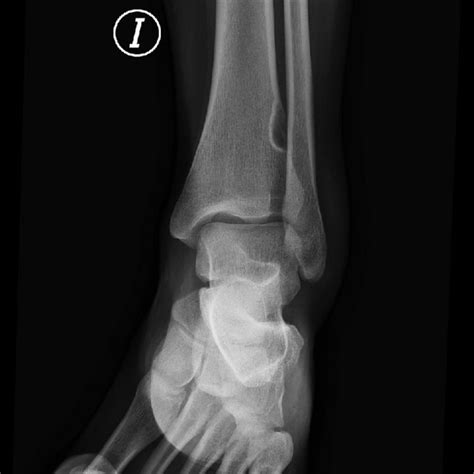 Radiograf A Simple De F Mur Proximal Proyecci N Anteroposterior