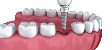 The Benefits of Dental Implants - Barry Levin