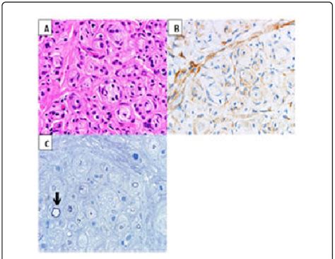 Fascicular Biopsy Left Sciatic Nerve A Hande 400x Intraneural