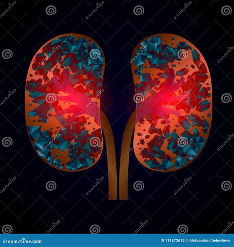 Nephrolithiasis Kidney Stones Disease. Vector Medical Illustration