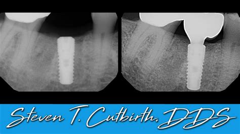 Implant Impression Abutment And Crown Seating Dental Minute With