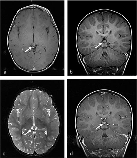 Non Trb Patient With Bilateral Retinoblastoma A D T1 Weighted Download Scientific Diagram