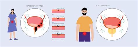 Premium Vector | Bladder cancer stages