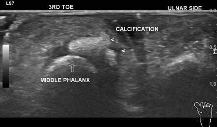 Acute Calcific Periarthritis Toe Radiology Case Radiopaedia Org