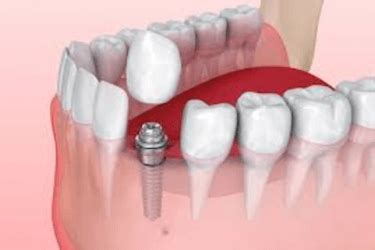 Complicaciones de los implantes dentales Clínica dental Dr Ferrer