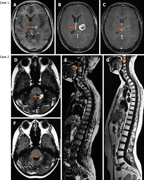 Brain Tumors Cancer Stem Like Cells Interact With Tumor Microenvironment