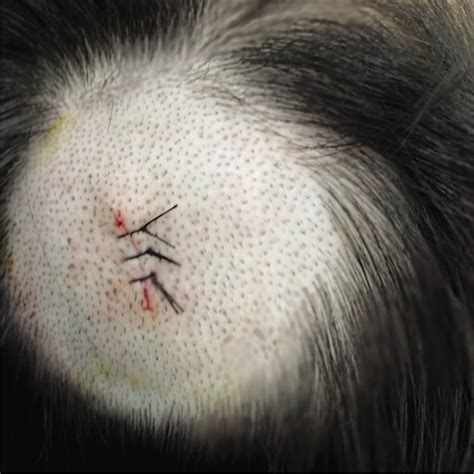 Cross fixation bandage with long hair on scalp wound after surgery ...