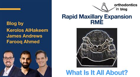 Rapid Maxillary Expansion Rme What Is It All About Orthodontics In