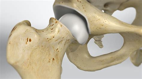 Ortho Blog | Slipped Capital Femoral Epiphysis (SCFE) Video