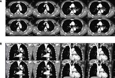 Frontiers A Case Report Of Pulmonary Hepatoid Adenocarcinoma