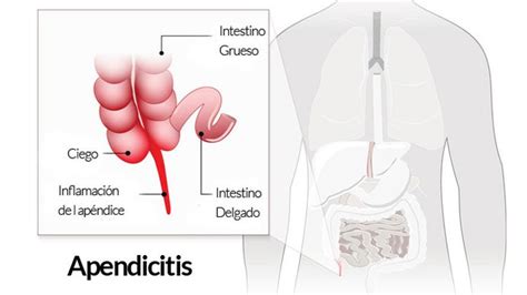 APENDICITIS Diez síntomas para reconocer un ataque de apendicitis