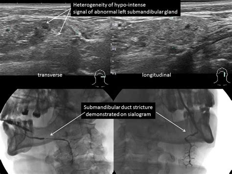 Submandibular Sialogram With Ductal Stricture Iowa Head And Neck Protocols