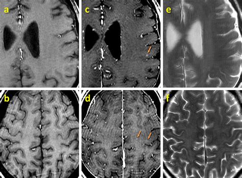 Figure 2 From Detection Of Cerebral Microvascular Lesions By 7 Tesla