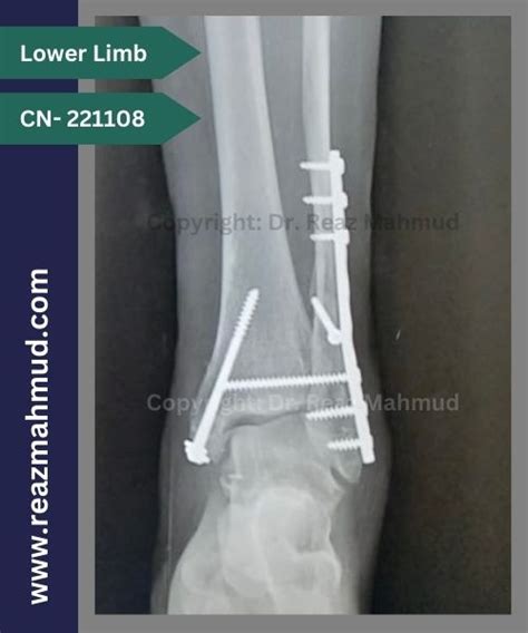 Trimalleolar Fracture | ORIF [CN-221108] - Dr. Reaz Mahmud