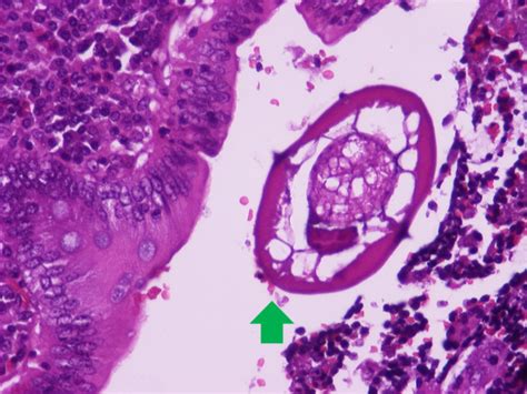 Cross Section Of E Vermicularis In The Appendiceal Lumen Note The Download Scientific Diagram