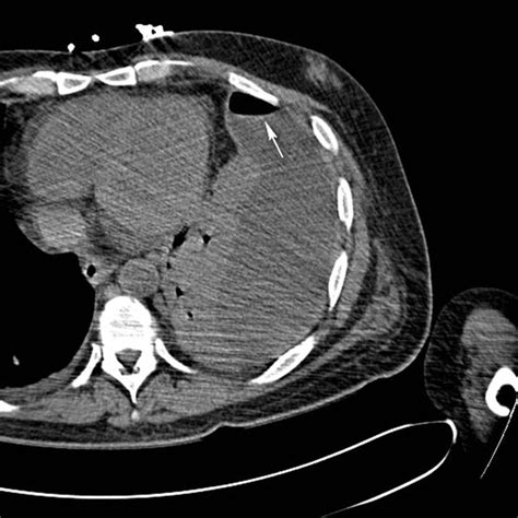 Loculated Pleural Effusion Ct Cureus Recurrent Large Volume Malignant Pleural Effusion In A