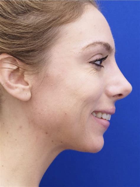 Ethnic Rhinoplasty Patient Case Mao Facial Plastics