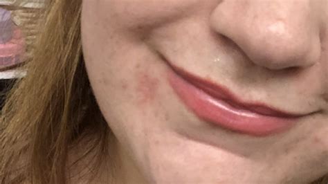 What Causes A Rash Around Lips