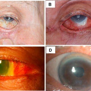 Pdf A Case Of Sight Threatening Complications From Topical