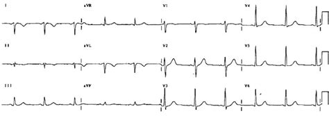 ECG Case 025 • LITFL • ECG Top 100 Self-Assessment Quiz