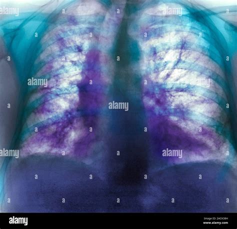 Fibrosing Alveolitis Coloured X Ray Of The Chest Of An Year Old Man