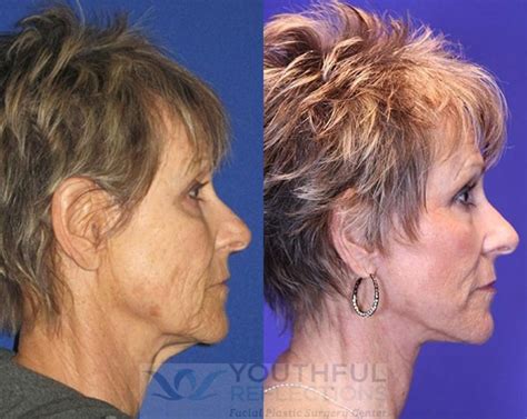 Facelift Reflection Lift Before After Photos Patient Nashville