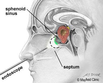 Optic Nerve Biopsy Procedure - mapasgmaes