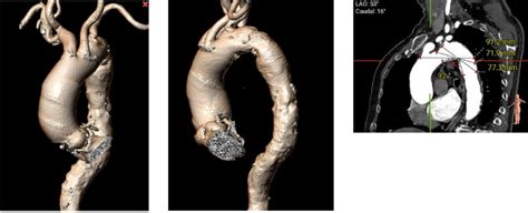 Tavr Pci